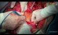 Cirugía citorreductora del cáncer de ovario. Resección en bloque del cáncer de ovario en estadio IIIC.