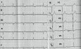 Miocardiopatía hipertrófica: ECG, ecocardiografía y tratamiento