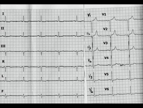 Miocardiopatía hipertrófica: ECG, ecocardiografía y tratamiento