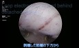 Mioma cervical enorme