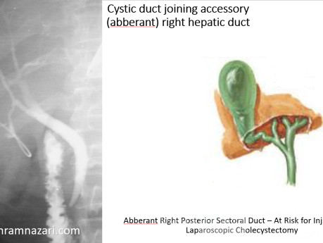 Unión del Conducto Cístico con un Conducto Hepático Derecho Accesorio (Aberrante)