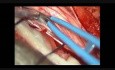 Tumor de médula espinal - Neurofibroma intradural - Escisión microquirúrgica