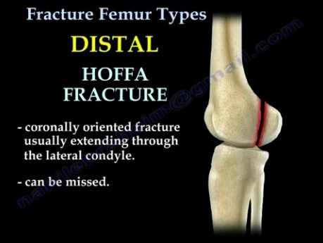 Tipos de fractura de fémur