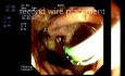 Fístula coledocoduodenal en la CPRE - Parte 2