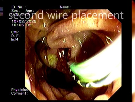 Fístula coledocoduodenal en la CPRE - Parte 2