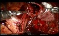 Condrosarcoma traqueal operado mediante cirugía robótica y asistencia de ECMO