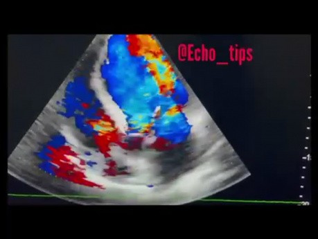 2. Ecocardiografía - ¿Qué se ve?