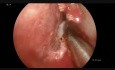 Septoplastia endoscópica, turbinoplastia y tratamiento de sinusitis unilateral