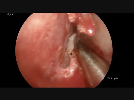 Septoplastia endoscópica, turbinoplastia y tratamiento de sinusitis unilateral