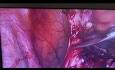 Escisión de endometrioma izquierdo