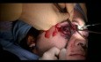 Tratamiento de múltiples fracturas faciales