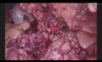 Enucleación de Pequeño Insulinoma Pancreático