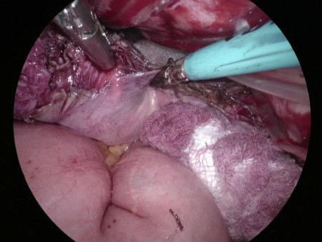 Cómo evitar lesiones intestinales durante la operación vNOTES
