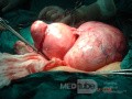 Mioma del ligamento ancho del útero