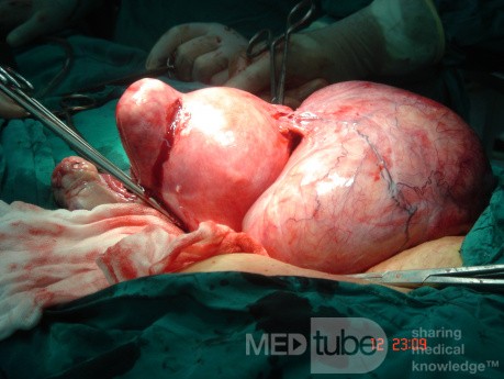 Mioma del ligamento ancho del útero