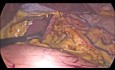 Gastrectomía en manga con hernia de hiato