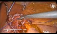 Conversión de gastrectomía vertical en manga a un mini bypass gástrico