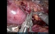 Nefrectomía de donante de riñón en herradura: Posible con ICG