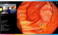 Colon cecal, pólipo plano de 20 milímetros, polipectomía híbrida subacuática