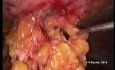 Escisión mesorrectal total laparoscópica con hernioplastia usando IPOM 