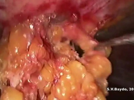 Escisión mesorrectal total laparoscópica con hernioplastia usando IPOM 