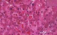 Hemocromatosis - histopatología - hígado