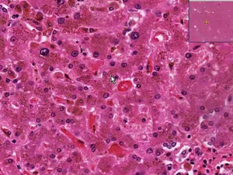 Hemocromatosis - histopatología - hígado