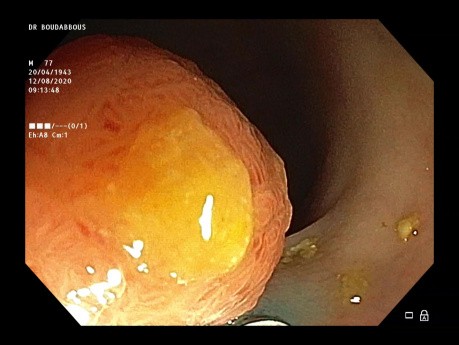 RME fragmentaria para pólipo LST-G del colon izquierdo