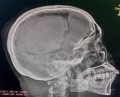 Craniectomía descompresiva en infarto maligno de la arteria cerebral media
