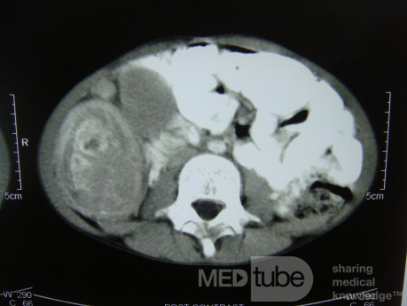 Intususcepción, linfoma no Hodgkin - TC