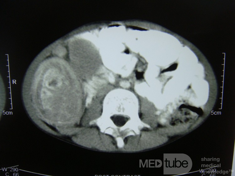 Intususcepción, linfoma no Hodgkin - TC