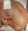 Craniectomía descompresiva en infarto maligno de la arteria cerebral media