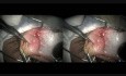 Doble dermolipoma de la conjuntiva - cirugía con utilización del Fugo Plasma