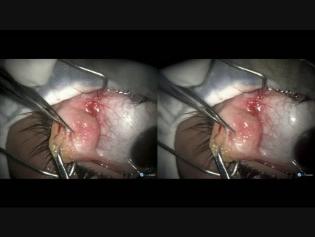 Doble dermolipoma de la conjuntiva - cirugía con utilización del Fugo Plasma