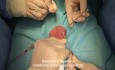Vasectomía sin bisturí (reversible)