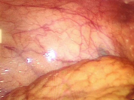 Tuberculosis peritoneal en laparoscopia