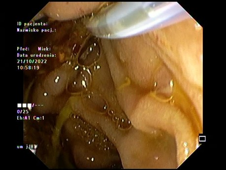 Colangitis purulenta