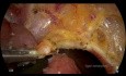 TAMİS - Cirugía mínimamente invasiva TransAnal para pólipos rectales malignos T1