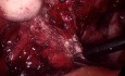 Endometriosis voluminosa del ciego y la pelvis