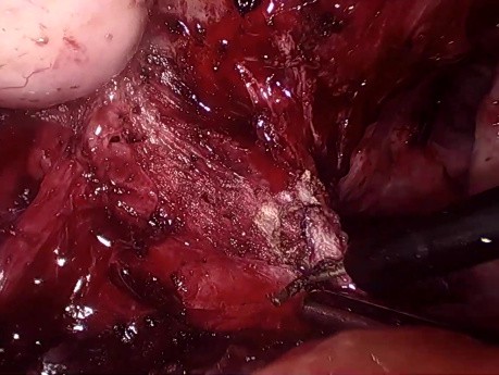 Endometriosis voluminosa del ciego y la pelvis
