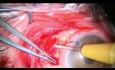 Implantación combinada de válvula de Ahmed y cierre de agujero macular