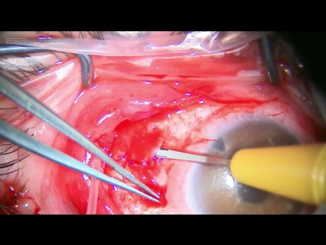 Implantación combinada de válvula de Ahmed y cierre de agujero macular