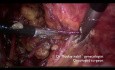 Histerectomía radical C1 en un caso raro de adenocarcinoma endocervical no obstructivo
