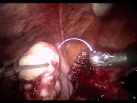 Extracción robótica de miomas uterinos con dos brazos adicionales