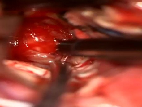 Craneotomía occipital izquierda y resección de lesión talámica