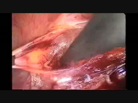 Linfadenectomía pélvica laparoscópica