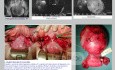 Mioma Cervical Sintomatico Histerectomia Abdominal