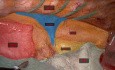 Exéresis de Divertículo esofágico por toracoscopia en decúbito prono