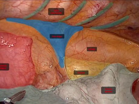 Exéresis de Divertículo esofágico por toracoscopia en decúbito prono