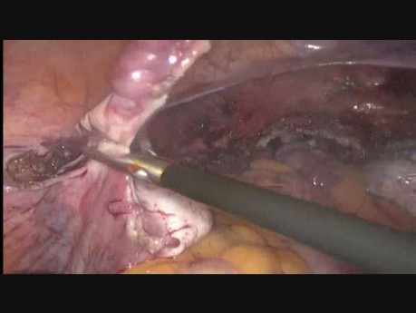 Histerectomía laparoscópica total en 24 semanas uterino fibroma de gran tamaño